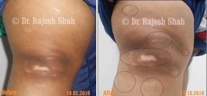 Vitiligo Before and After Case Photo