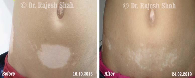 Vitiligo Before and After Case Photo