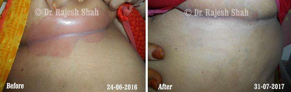 Psoriasis Before and After Case Photo