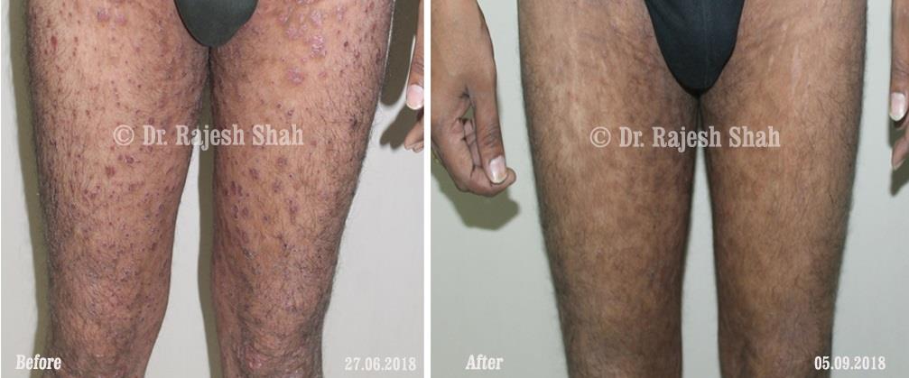 Psoriasis Before and After Case Photo
