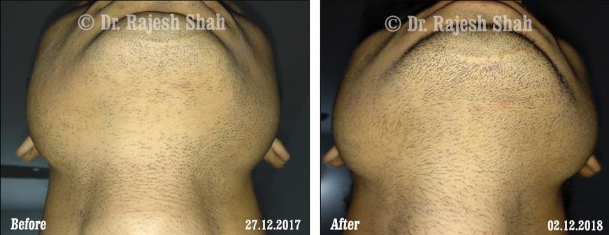 Alopecia Areata Before and After Case Photo