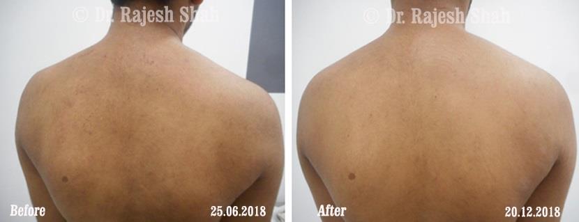 Atopic Dermatitis Before and After Case Photo