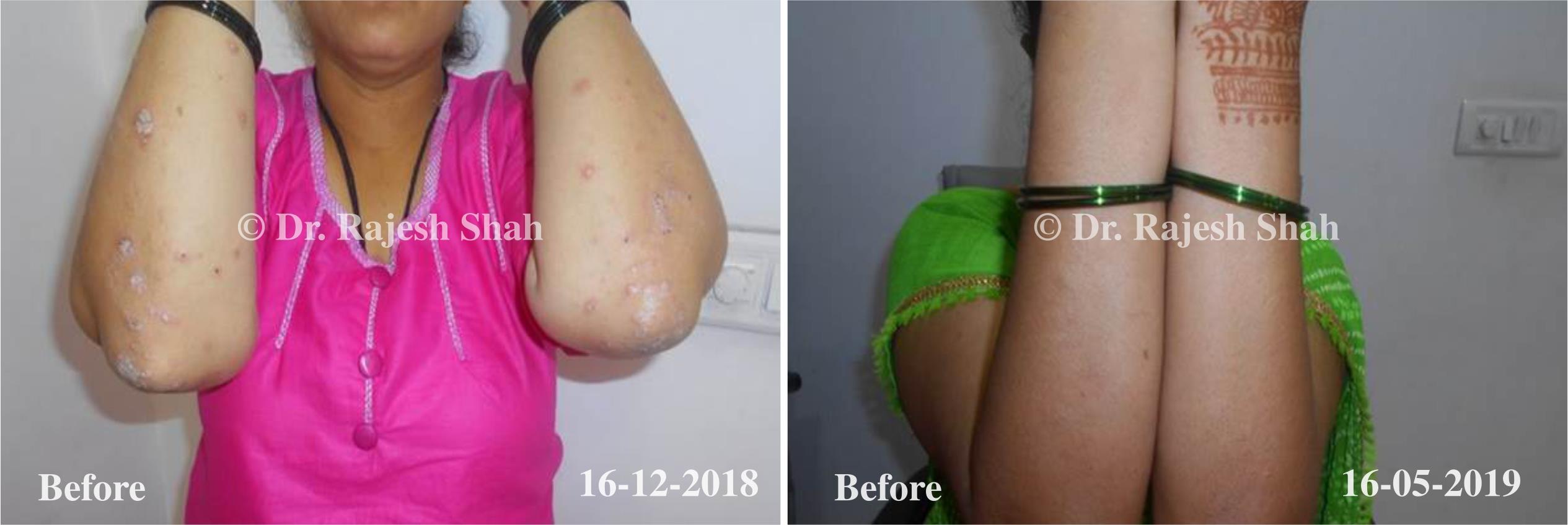 Psoriasis Before and After Case Photo