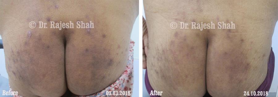 Lichen Planus Before and After Case Photo