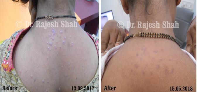 Lichen Planus Before and After Case Photo