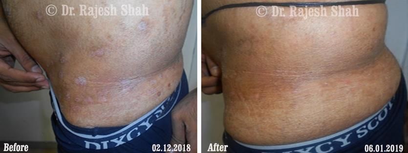 Psoriasis Before and After Case Photo