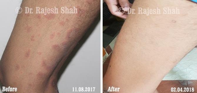 Lichen Planus Before and After Case Photo