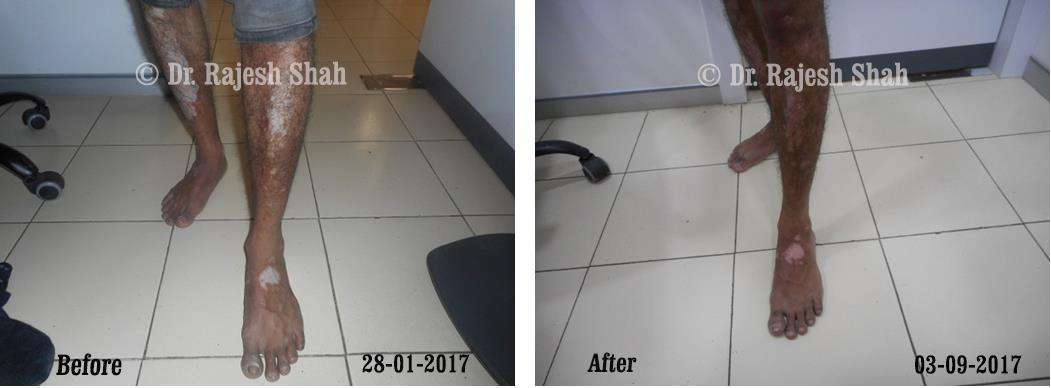 Vitiligo Before and After Case Photo