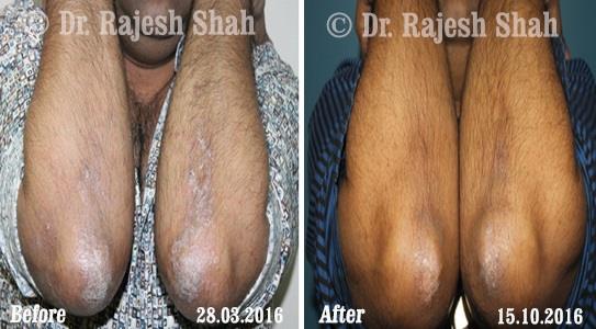 Psoriasis Before and After Case Photo