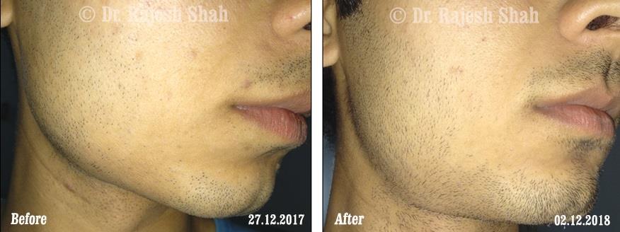 Alopecia Areata Before and After Case Photo