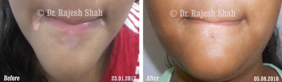 Vitiligo Before and After Case Photo