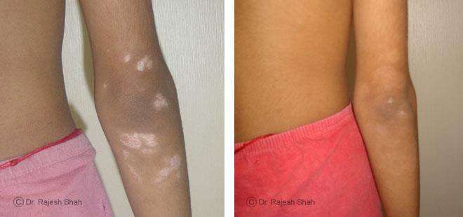 Psoriasis Before and After Case Photo