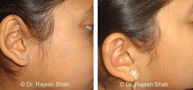 Eczema Before and After Case Photo