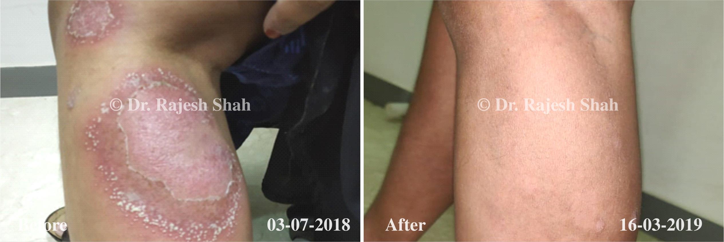 Psoriasis Before and After Case Photo