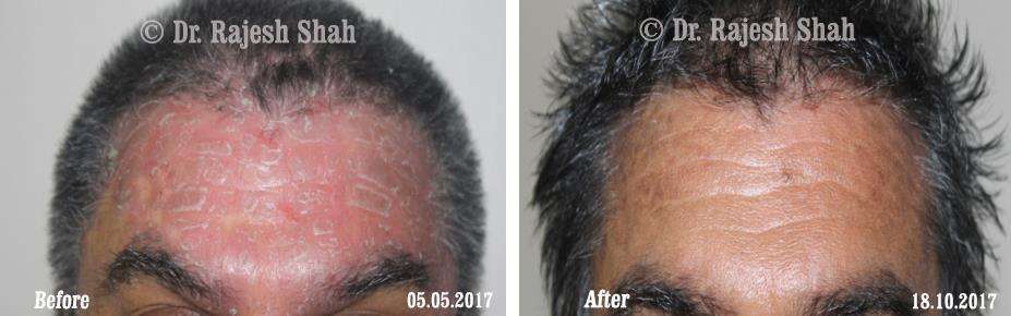 Psoriasis Before and After Case Photo