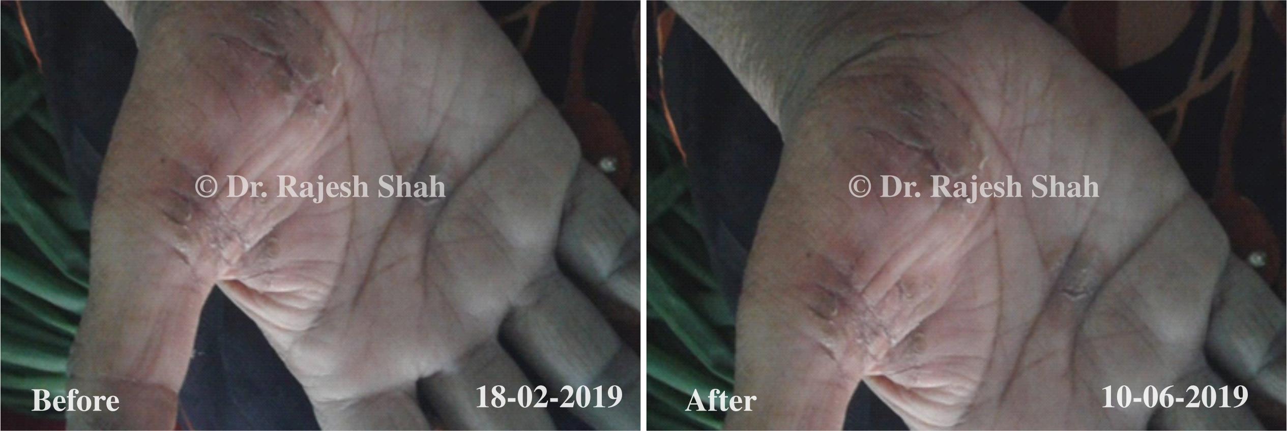 Atopic Dermatitis Before and After Case Photo