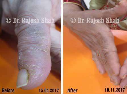 Psoriasis Before and After Case Photo