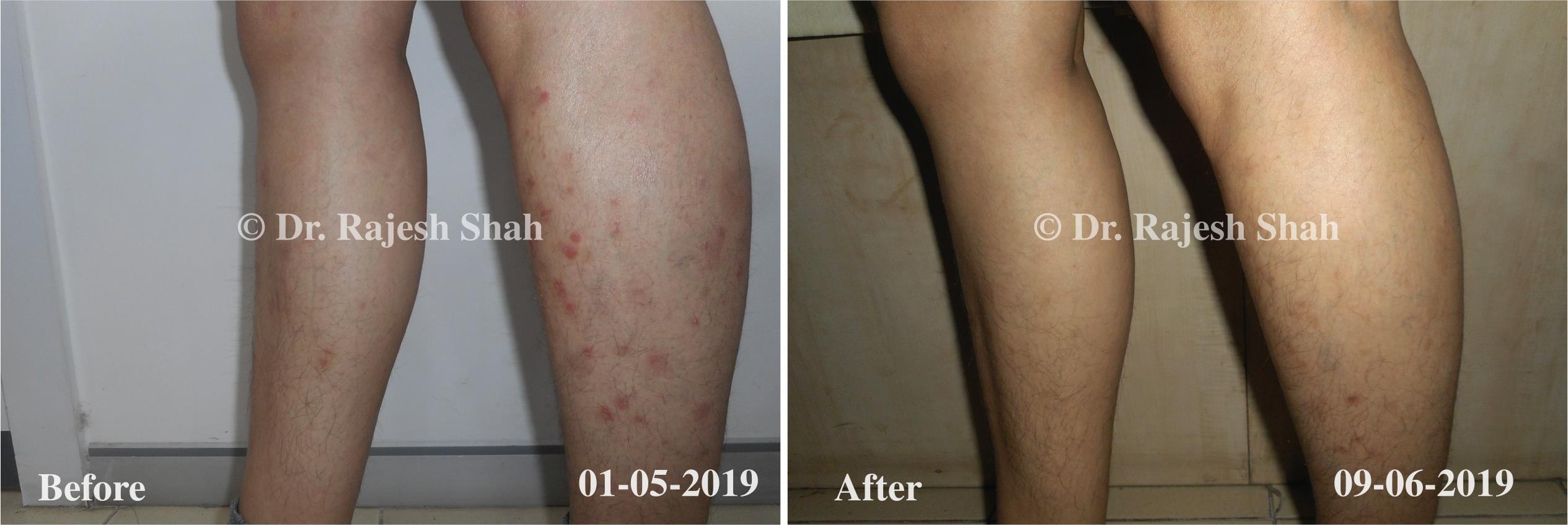 Psoriasis