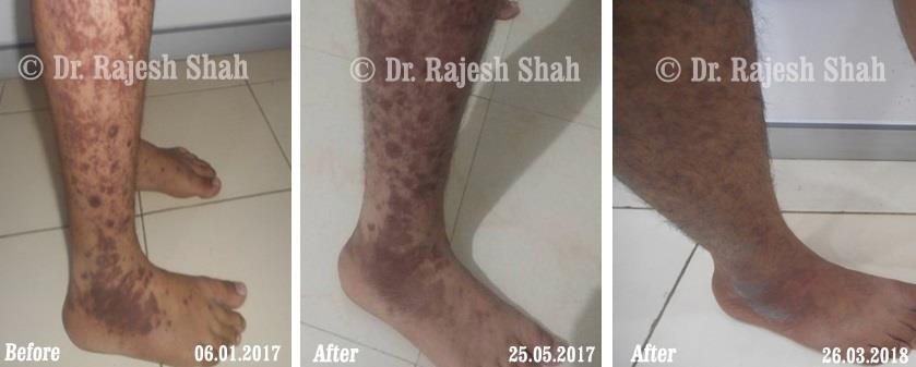 Lichen Planus Before and After Case Photo