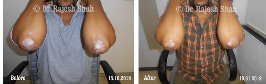 Psoriasis Before and After Case Photo