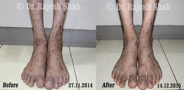 Lichen Planus Before and After Case Photo