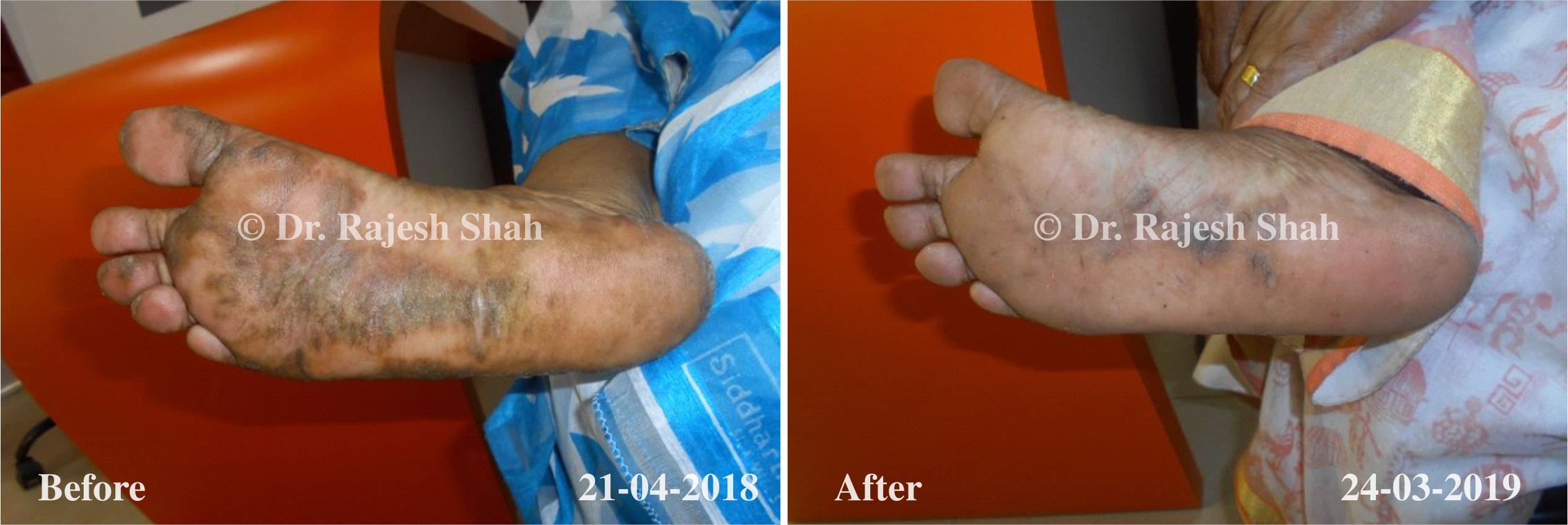 Before and After Case Photo