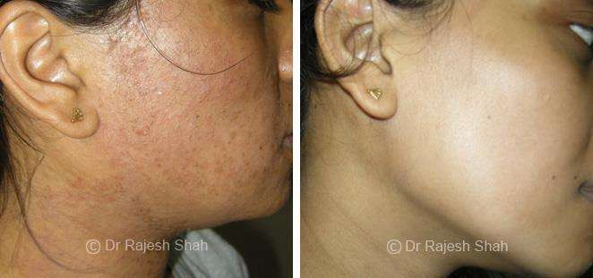 Eczema Before and After Case Photo