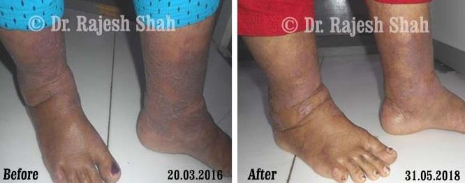 Psoriasis Before and After Case Photo