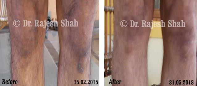 Lichen PlanusBefore and After Case Photo