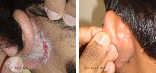 Psoriasis Before and After Case Photo