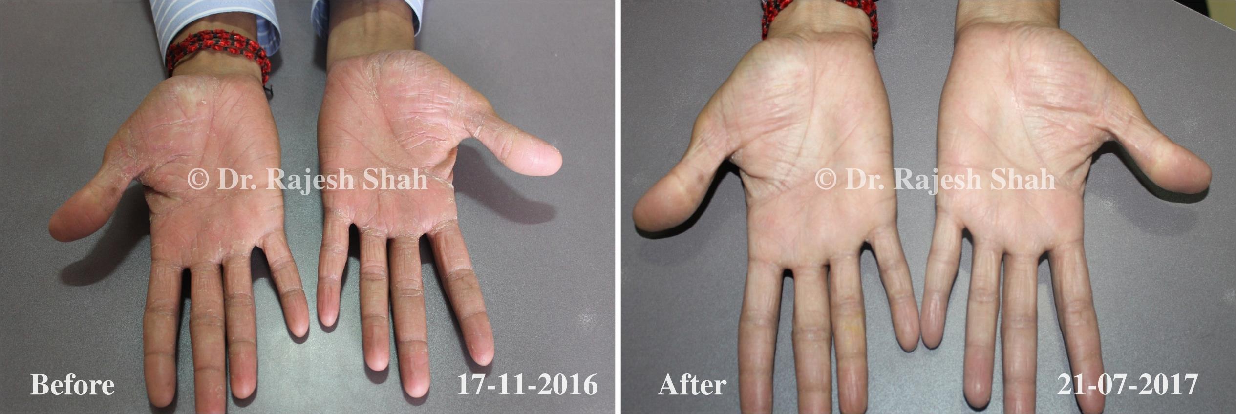 Psoriasis Before and After Case Photo