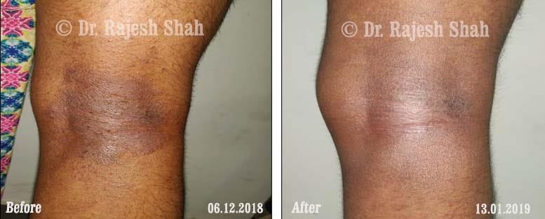 Atopic Dermatitis Before and After Case Photo