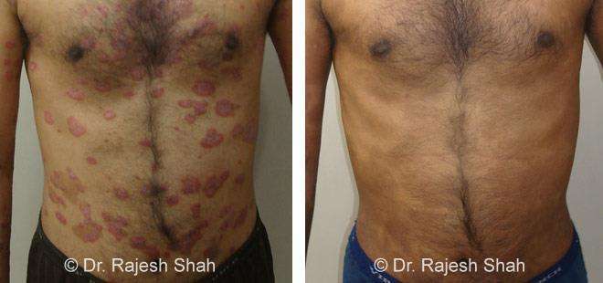 Psoriasis Before and After Case Photo