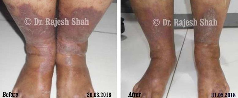 Psoriasis Before and After Case Photo