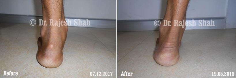 Vitiligo Before and After Case Photo