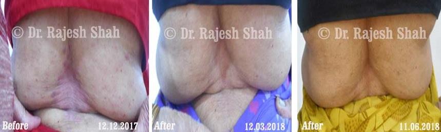 Psoriasis Before and After Case Photo