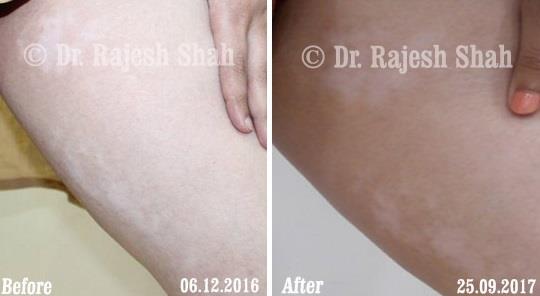 Vitiligo Before and After Case Photo