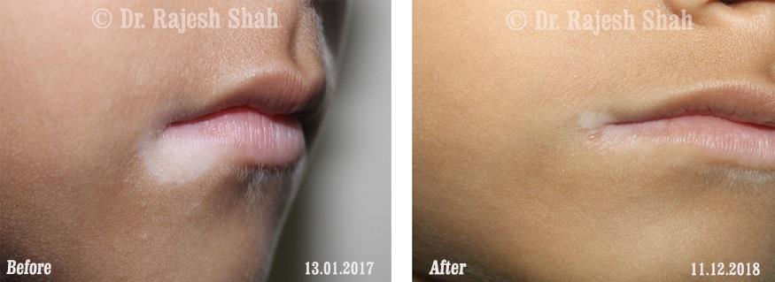 Vitiligo Before and After Case Photo