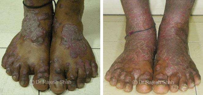 Psoriasis Before and After Case Photo