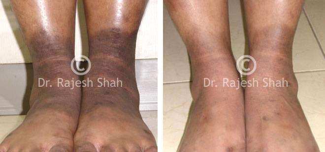 Psoriasis Before and After Case Photo