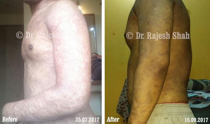 Psoriasis Before and After Case Photo