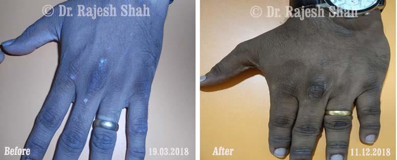 Psoriasis Before and After Case Photo