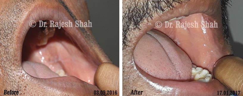 Lichen Planus Before and After Case Photo