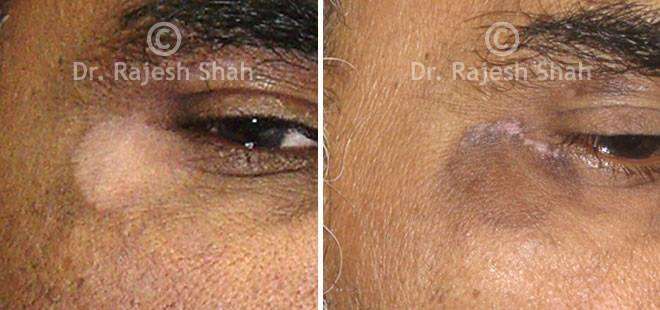 Vitiligo Before and After Case Photo