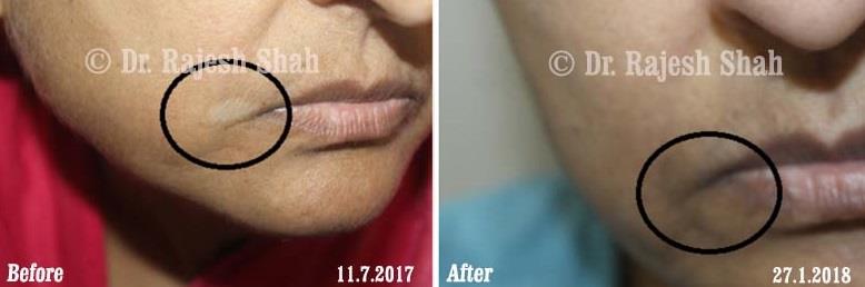 Vitiligo Before and After Case Photo