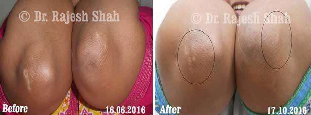 Vitiligo Before and After Case Photo