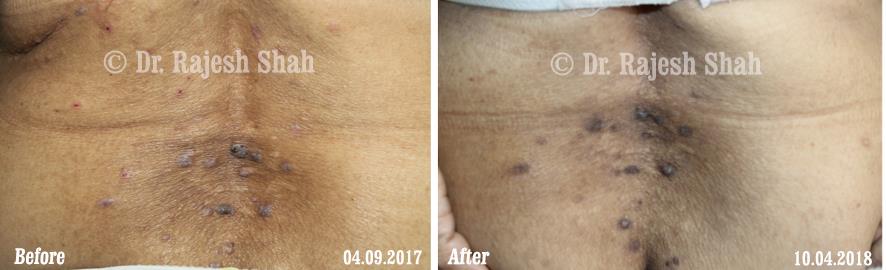 Lichen Planus Before and After Case Photo