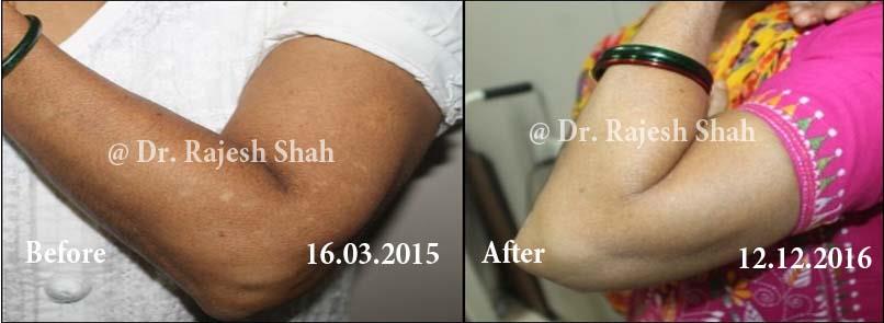 Vitiligo Before and After Case Photo