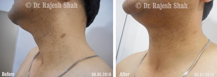 Lichen Planus Before and After Case Photo