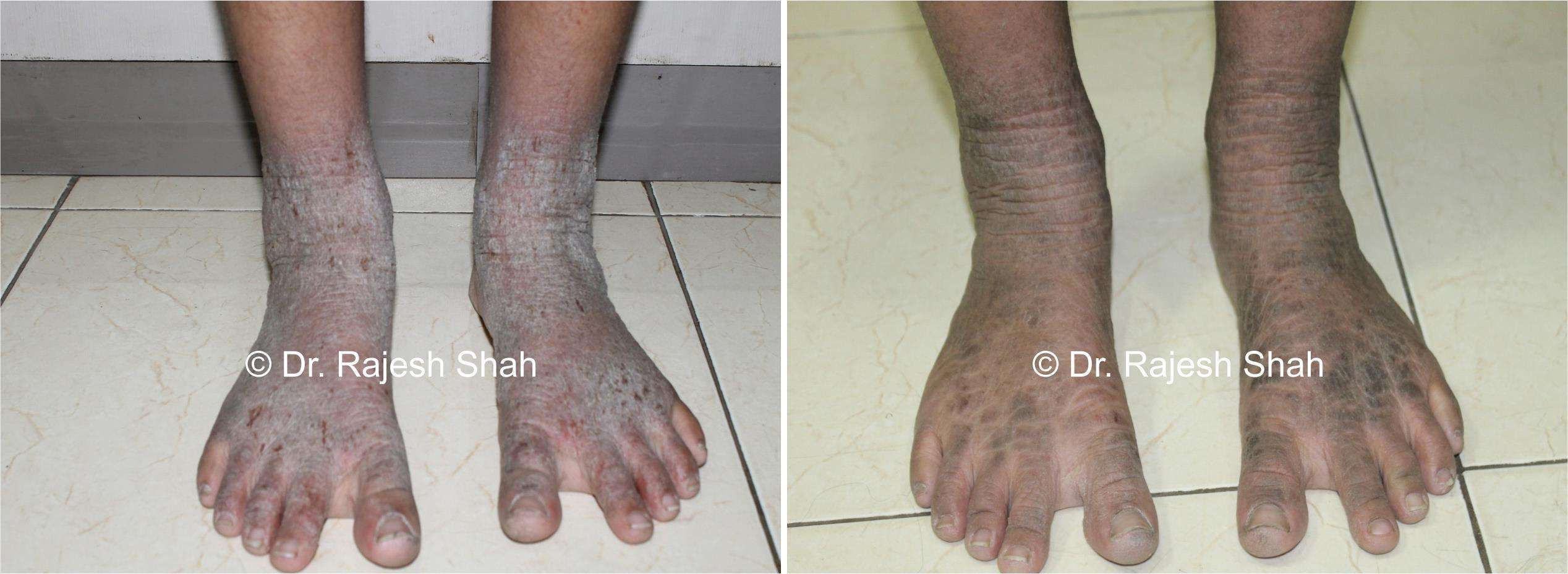 Atopic Dermatitis Before and After Case Photo